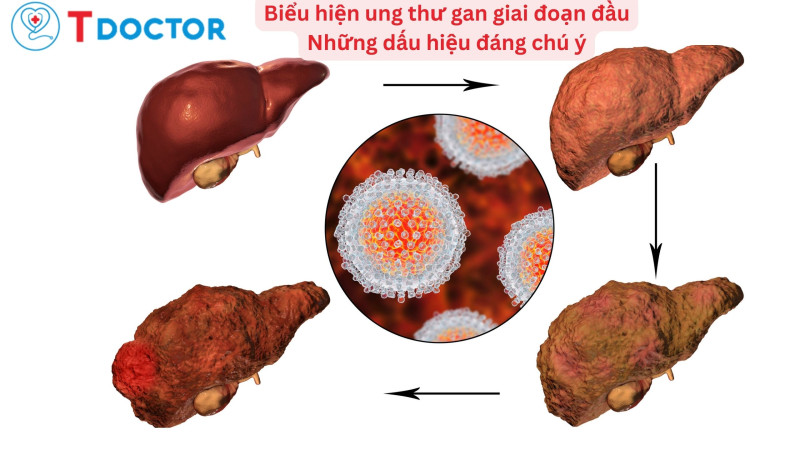 TDOCTOR - Biểu hiện ung thư gan giai đoạn đầu: Những dấu hiệu đáng chú ý